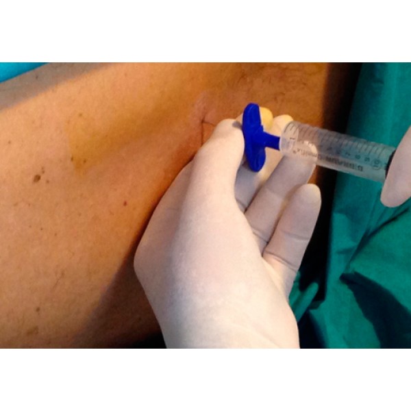 Ozone Therapy for Lumbar Spinal Stenosis – Mechanisms of Action and Therapeutic Potential